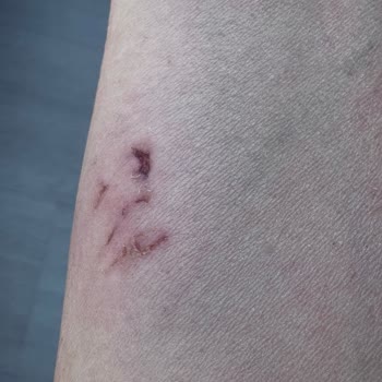 Cinatı Köpek Isırmasına Maruz Kaldım