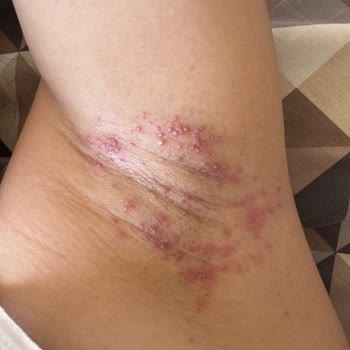 Uraw Lazer Etkili Tüy Dökücü Kremi Ciltte Şiddetli Yanma Ve Kabarcıklara Yol Açtı