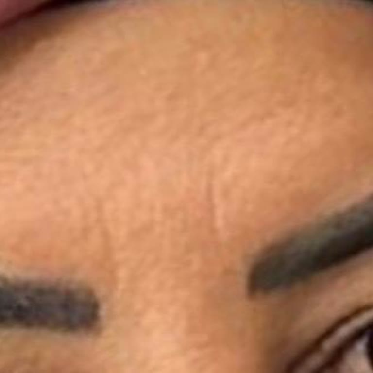 Kaşlarımda Hatalı Microblading Ve İade Talebi
