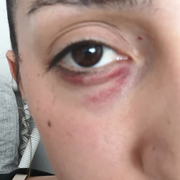 Cam Kırma Çekicinin Düşmesiyle Göz Yaralanması Ve Sorumluluk Reddi