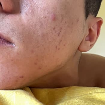 Acnemix Jel Kremi Kullanımından Sonra Sivilcelerde Belirgin Artış Ve Cilt Bozulması