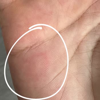 Fitamine Atakent Şubesinde EMS Seansı Sonrası Alerjik Reaksiyon Ve İade Sorunları