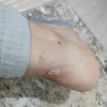 İki Hafta İçinde Aşınan Ve Ayağımı Yaralayan Spor Ayakkabıya İade Reddi