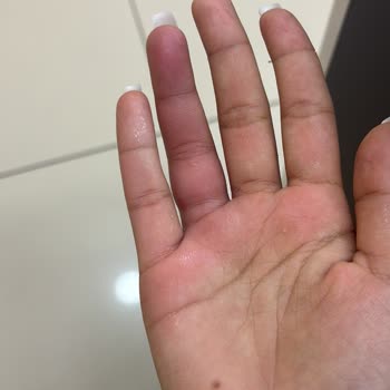 Alyansın Ölçü Hatası Nedeniyle Sağlık Sorunu Ve Mağaza Tarafından Ek Ücret Talebi