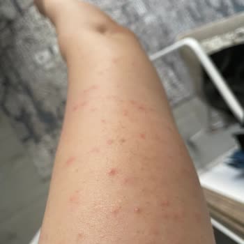 Epify Tüy Dökücü Kremi Kullanımından Sonra Şiddetli Kıl Kökü İltihabı