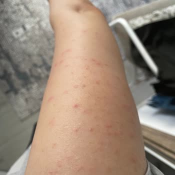 Epify Tüy Dökücü Kremi Kullanımından Sonra Şiddetli Kıl Kökü İltihabı
