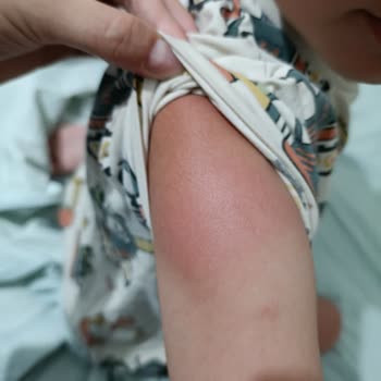 Nivea Sun Kids Kullanımına Rağmen Çocuğumda Şiddetli Güneş Yanığı Ve Cevapsız Şikayet