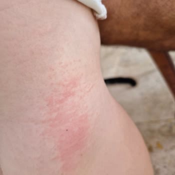 Prima Aktif Bebek 6 Numaralı Bezde Şiddetli Cilt Tahrişi Ve Yaralar