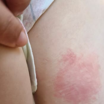 Prima Aktif Bebek 6 Numaralı Bezde Şiddetli Cilt Tahrişi Ve Yaralar