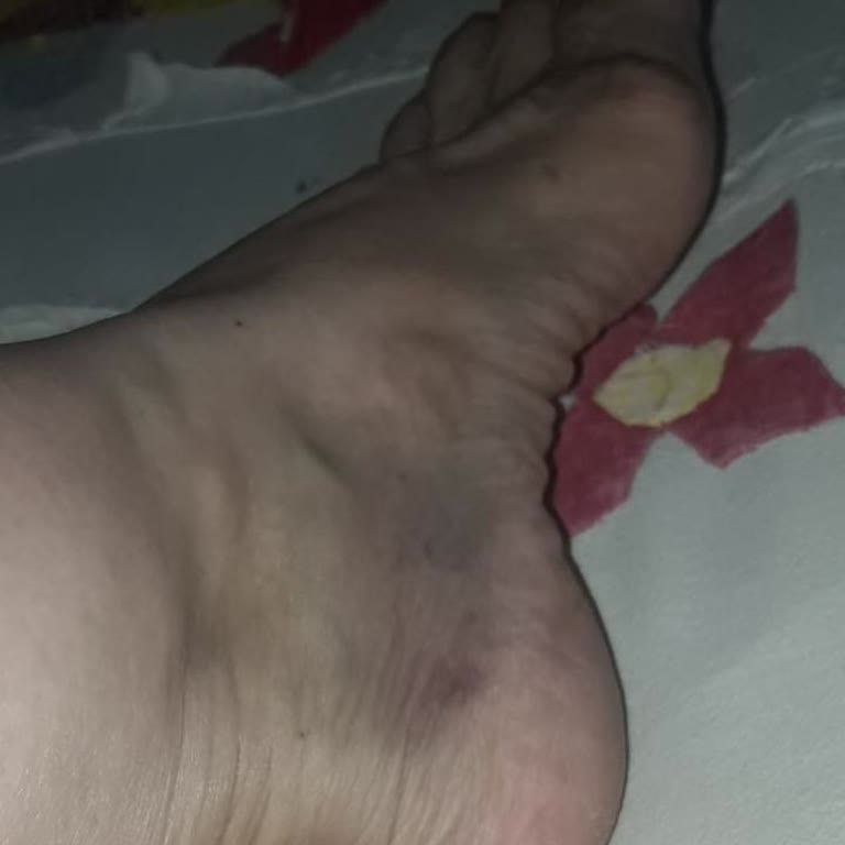 Özkaya Tıp Merkezi'nde Fizik Tedavi Sonrası Şiddetli Ağrı Ve Ödem Hastada Durumu Kötüleşti