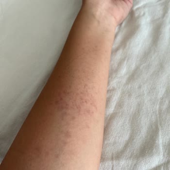Bayer Primolut N Tabletinin Yan Etkisi Olarak Kol Üzerinde Kızarıklık Ve Döküntü