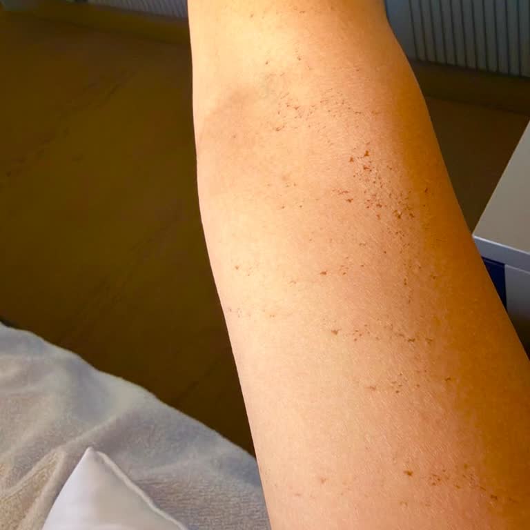 Eli Beauty İşlemden Sonra Kolumda Ciddi Yanıklar Ve Lekeler Oluştu