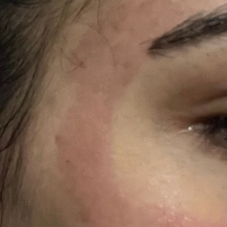 Isana Aktif Kömür Peeling Ürününde Şiddetli Cilt Tahrişi