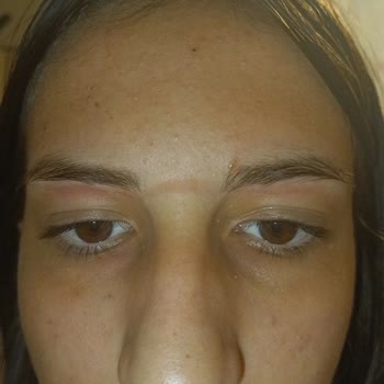 Bee Beauty Ağda Bandı Cildimde Şiddetli Yanma Ve Şişlik Yarattı