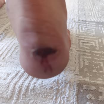 Çocuk Ayakkabısının Ayağa Derin Yaralar Açması Ve İade Talebi