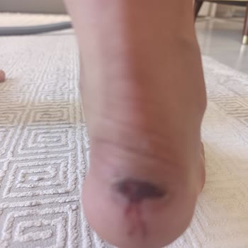 Çocuk Ayakkabısının Ayağa Derin Yaralar Açması Ve İade Talebi