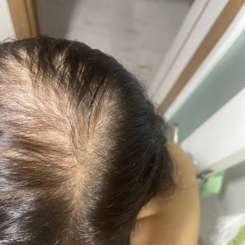 Bioxin Şampuanı Saç Dökülmesini Artırdı, İade Ve Özür Bekliyorum