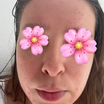 Bepanthol Sensiderm Kremi Yüzümde Şiddetli Kızarıklık Ve Kabarıklık Yarattı