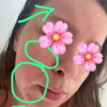 Bepanthol Sensiderm Kremi Yüzümde Şiddetli Kızarıklık Ve Kabarıklık Yarattı
