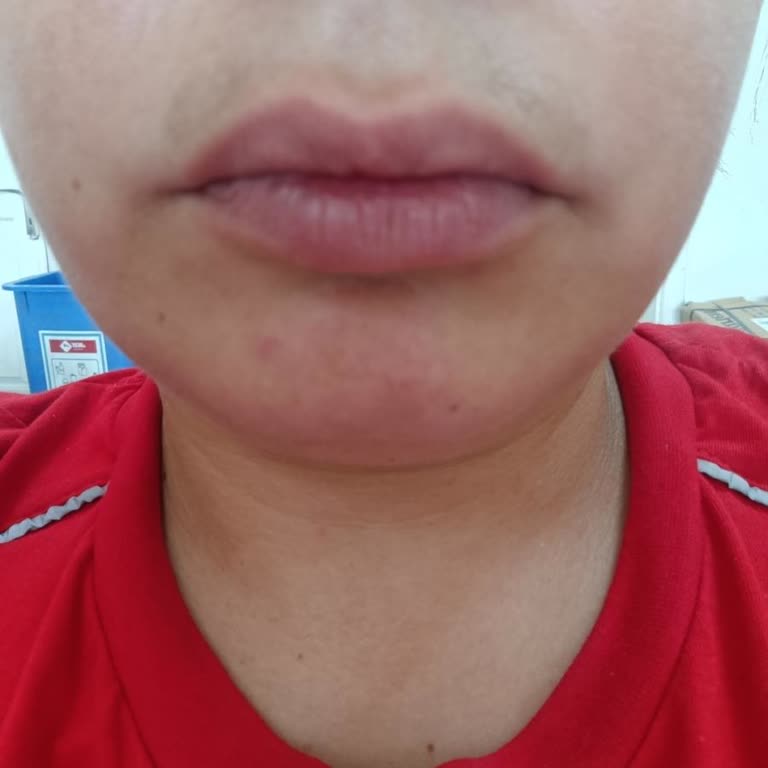 Yanık Ve Leke Bırakan Bozuk Philips Lumea Cihazı İçin Sıfır Değişim Ve Tam Tazminat Talebi