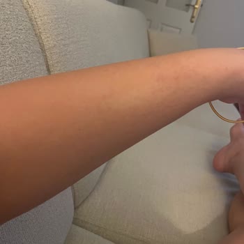 Hamilelikte Mustela Çatlak Kremi Alerjik Reaksiyon Yarattı