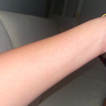 Hamilelikte Mustela Çatlak Kremi Alerjik Reaksiyon Yarattı