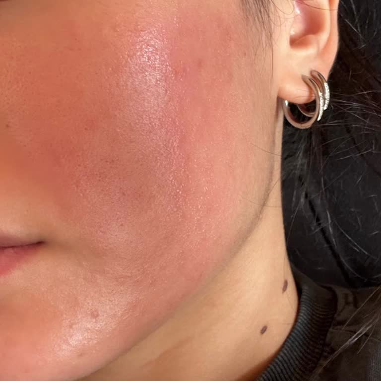 Alerjik Reaksiyon Nedeniyle Creamco Cloud Moisturizer Ürününün İadesi Ve İncelenmesi Talebi