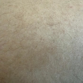 Nazan Gürgen Beauty Center Çok Sayıda Seansa Rağmen Kıllarda Neredeyse Hiçbir Azalma Olmadı