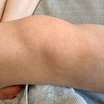 Nazan Gürgen Beauty Center Çok Sayıda Seansa Rağmen Kıllarda Neredeyse Hiçbir Azalma Olmadı