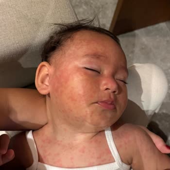 Bebek Ve Anne Sağlık Sorunları Otel Sorumluluğunda, Tazminat Talebi