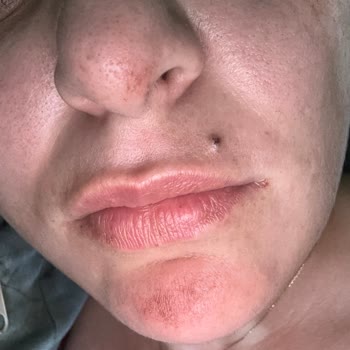 Bee Beauty Pirinç Peeling Jelinde Şiddetli Yanma Ve Cilt Tahrişi