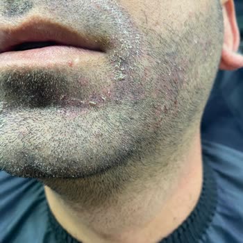 Yves Rocher Şampuanı Kepek Sorununu Çözmedi