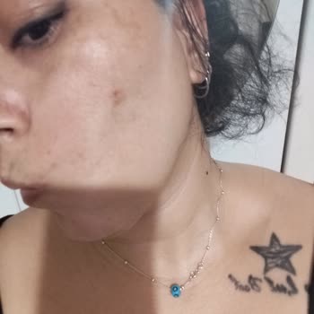 Frankly PDRN Ball Serum Kullanımının Ardından Şiddetli Akne Ve Komedon Patlaması