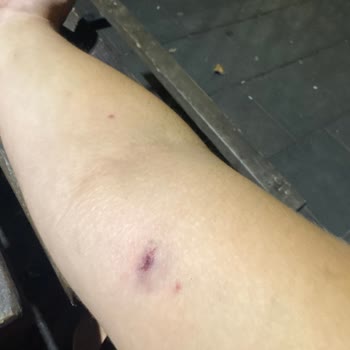 Balıkesir Hükümet Caddesi Parkında Kırılan Salıncağın Yarattığı Ciddi Yaralanma