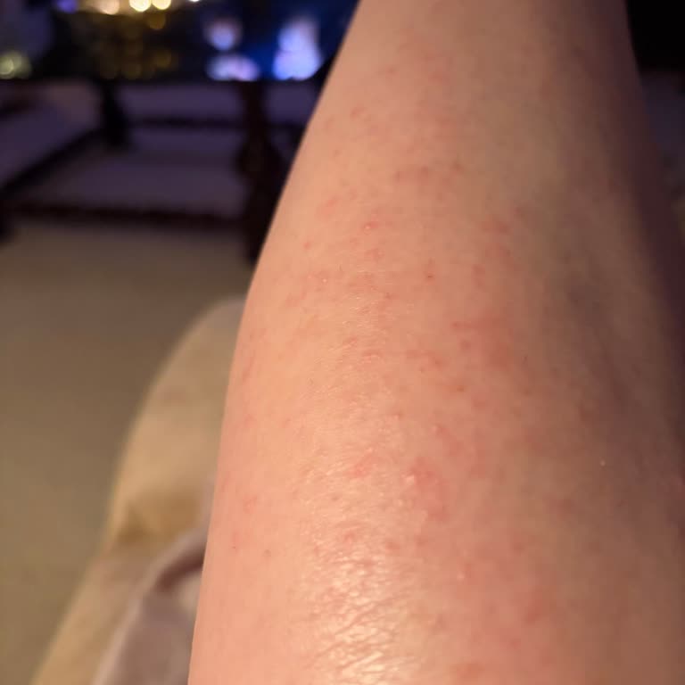 Inflammatory Reaction To Shaving With Gillette Venus, Moisture, Pad Razor