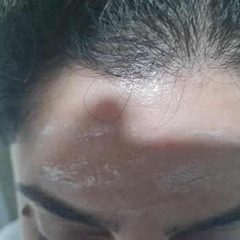 Bioderma Güneş Kremi Sahte Şüphesi Ve Ciltte Yan Etki