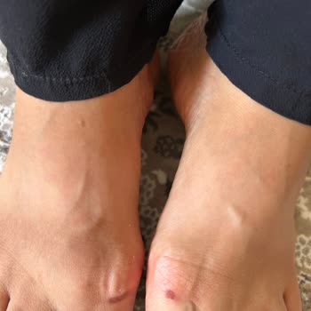 Ayak Tahrişi Yapan Terliğin İade Talebim Reddedildi