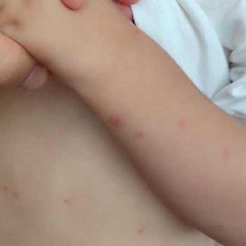 Çocuğum Sinek Kovucu Losyondan Şiddetli Alerjik Reaksiyon Yaşadı