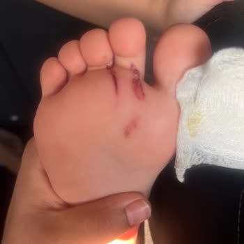 Ducale Lara Otelinde Çocuk Havuzunda Güvenlik İhmali Sonucu Ağır Kaza Ve Ücret İadesi Talebi