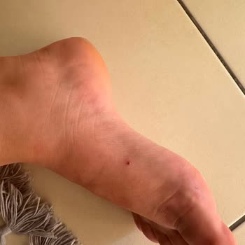 Ayağımda Yara Açan Sandalet İçin Üretim Hatası Reddine Karşı Şikayet