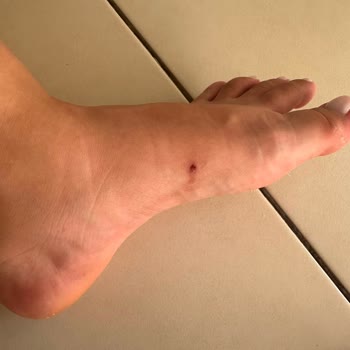 Ayağımda Yara Açan Sandalet İçin Üretim Hatası Reddine Karşı Şikayet