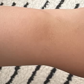 Huawei Band 10 Cilt Yanığı Ve Çözüm İçin Değişim Talebi