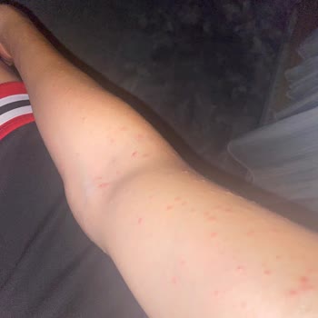 Veet Kremi Alerjik Sivilce Ve Müşteri Hizmetlerinin İlgisizliği