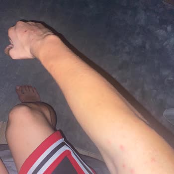 Veet Kremi Alerjik Sivilce Ve Müşteri Hizmetlerinin İlgisizliği