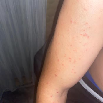 Veet Kremi Alerjik Sivilce Ve Müşteri Hizmetlerinin İlgisizliği