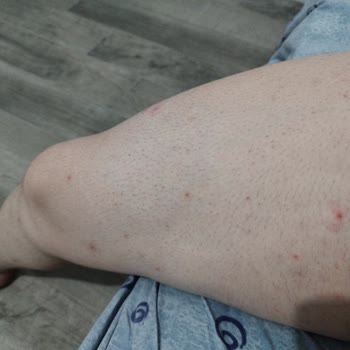 Veet Men Kremi Ciltte Şiddetli Yanma Ve Çıban Oluşturdu