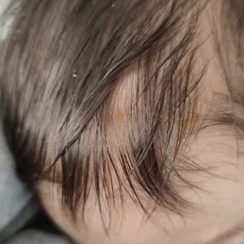 Bebek Cildinde Şiddetli Kuruluk Ve Konak Oluşumu: Mustela Şampuanı Nedeniyle Yaşanan Sorunlar