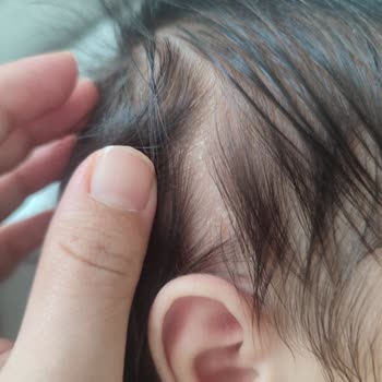 Bebek Cildinde Şiddetli Kuruluk Ve Konak Oluşumu: Mustela Şampuanı Nedeniyle Yaşanan Sorunlar