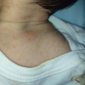 Bebek Cildinde Şiddetli Kuruluk Ve Konak Oluşumu: Mustela Şampuanı Nedeniyle Yaşanan Sorunlar
