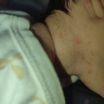 Bebek Cildinde Şiddetli Kuruluk Ve Konak Oluşumu: Mustela Şampuanı Nedeniyle Yaşanan Sorunlar